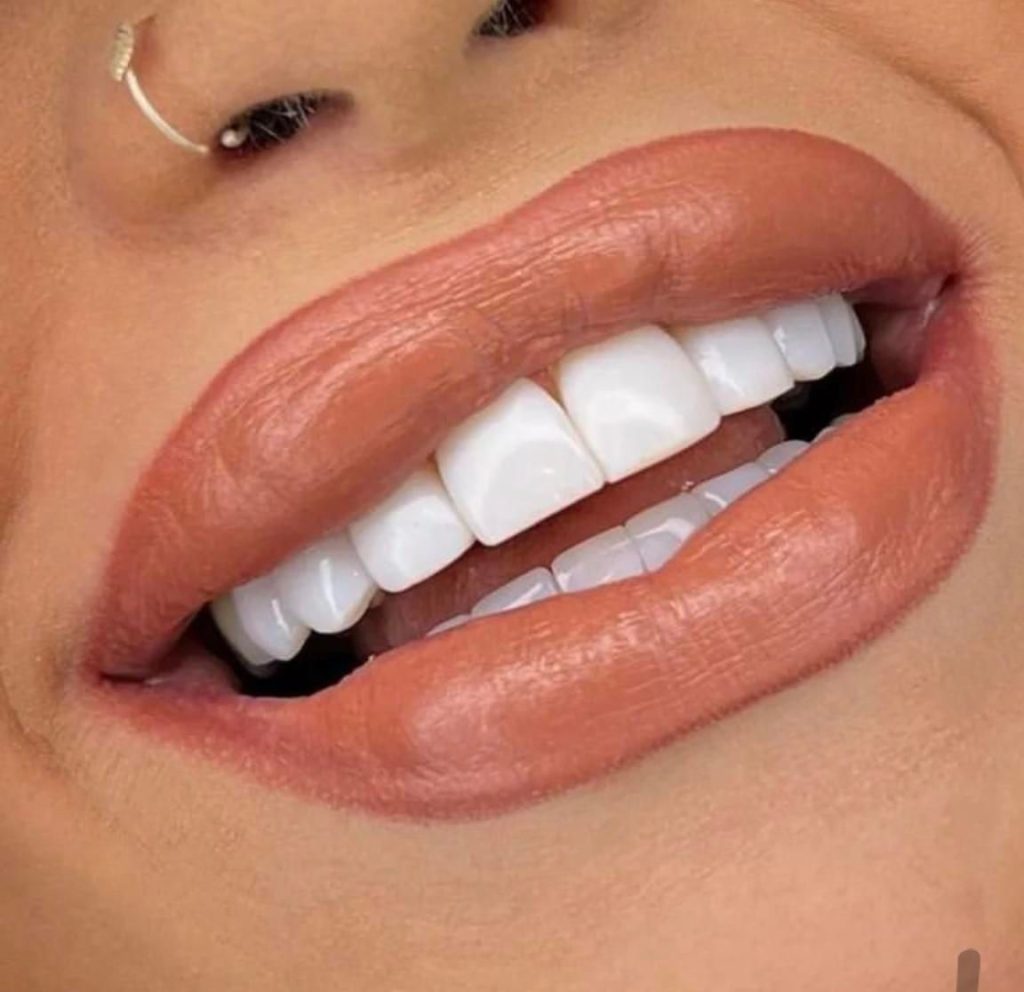 کامپوزیت دندان/ایمپلنت/لمینت/دندانپزشکی