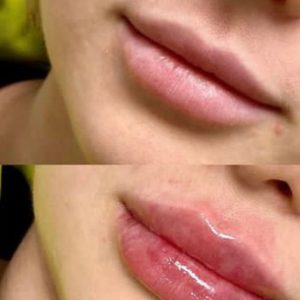 جشنواره تزریق ژل و بوتاکس