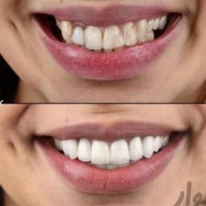 دندانپزشکی شرق (ایمپلنت کامپوزیت عصبکشی روکش)
