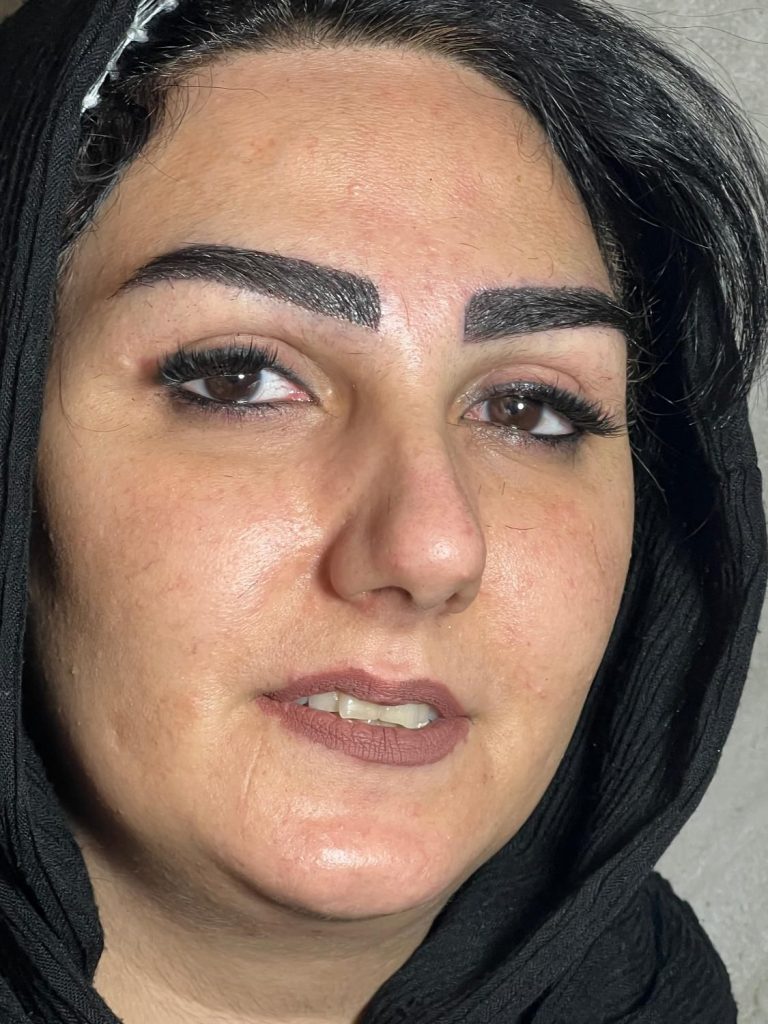 کاشت ابرو تخصصی